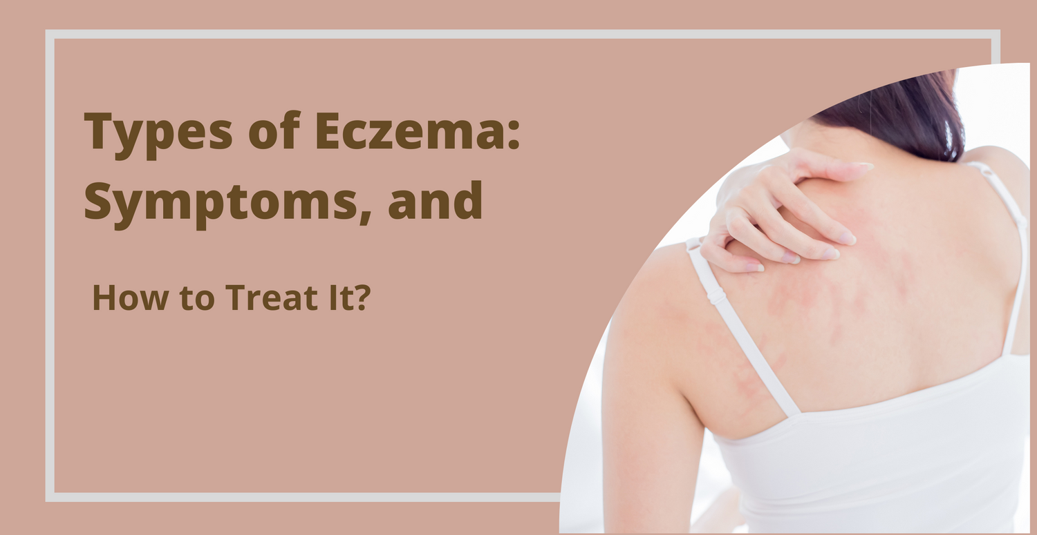 Types of Eczema: Symptoms, and How to Treat It?
