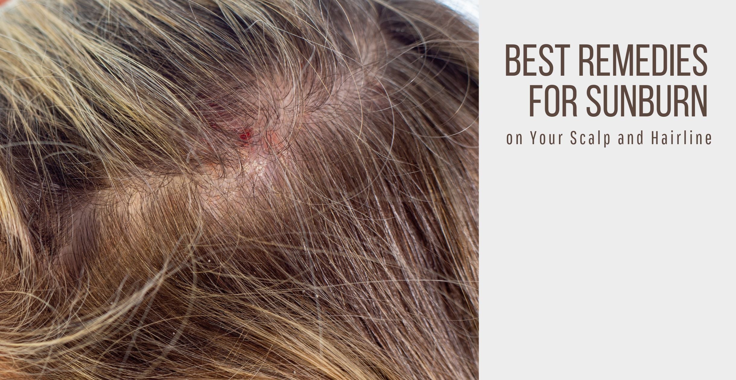 close-up of a person's scalp and hair showing visible sunburn and redness along the hairline