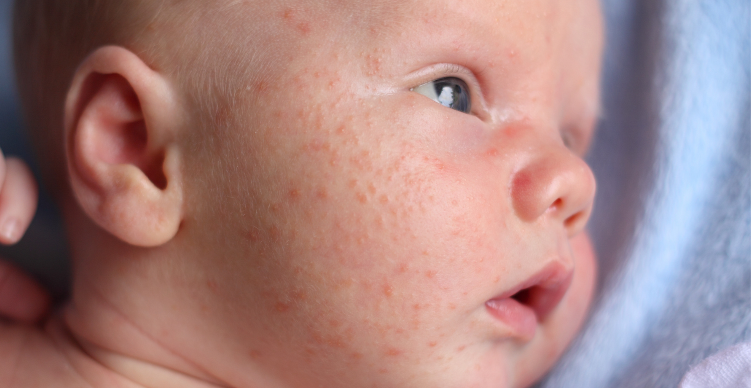 Prevent and treat baby acne