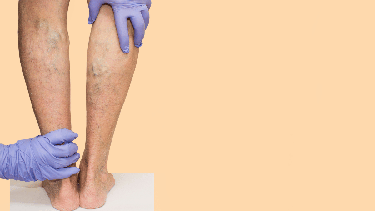 Understanding Varicose Veins: Causes, Symptoms, and Treatment