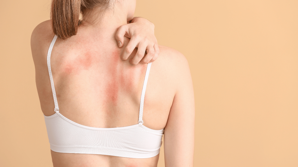 Sports bra rash- I noticed this rash that's right in line with