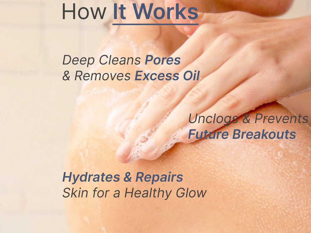 Wild Oak 5% Benzoyl Peroxide Acne Wash For Face & Body