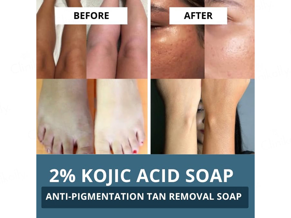 Bake 2% Kojic Acid + Alpha Arbutin Anti-Pigmentation Soap (Pack Of 2)
