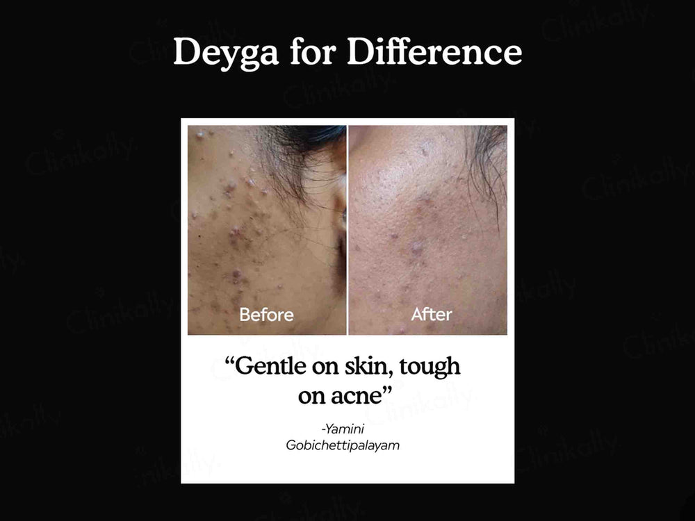 Deyga Charcoal Bath Bar For Acne Control & De-Tan