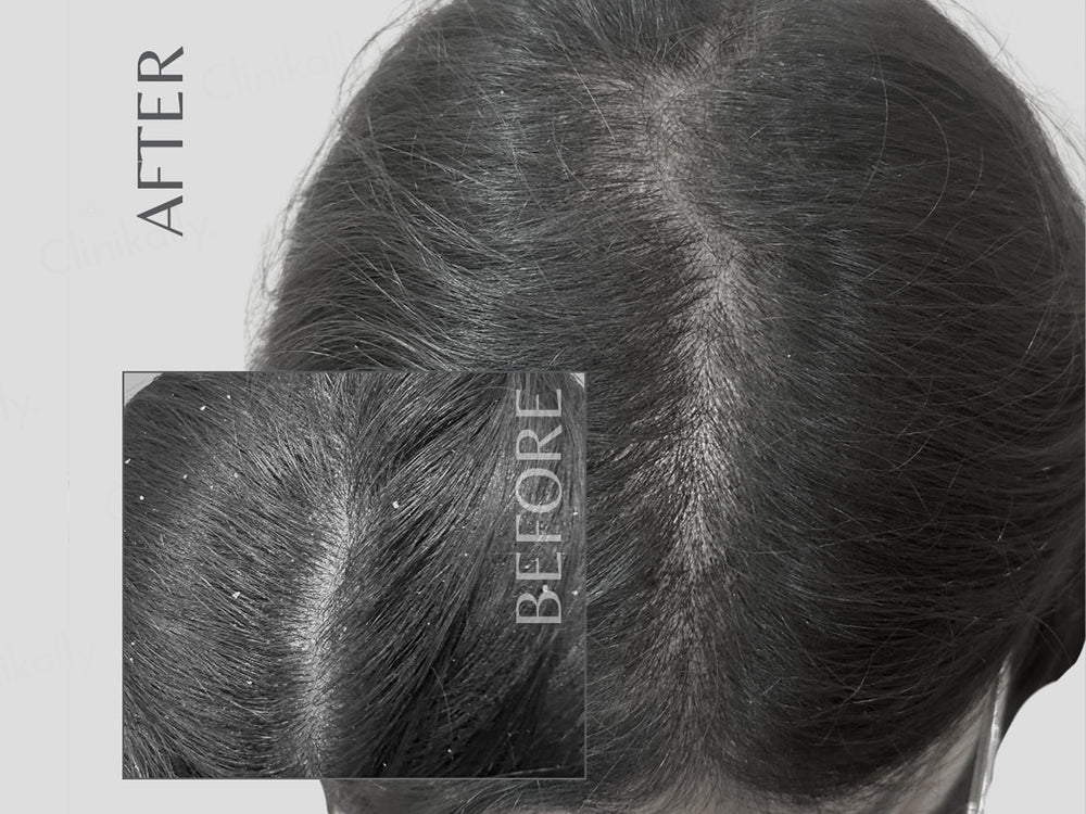 EnagenBio Degrease Pro Anti-Dandruff Scalp Serum