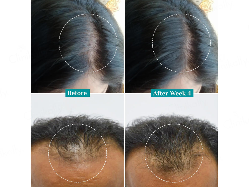 Pilgrim 3% Redensyl & 4% Anagain Advanced Hair Growth Serum With Korean Black Rice