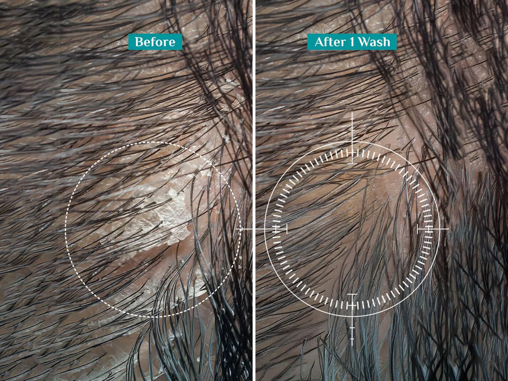 Pilgrim Australian Tea Tree & Salicylic Acid Non-Drying Anti-Dandruff Shampoo