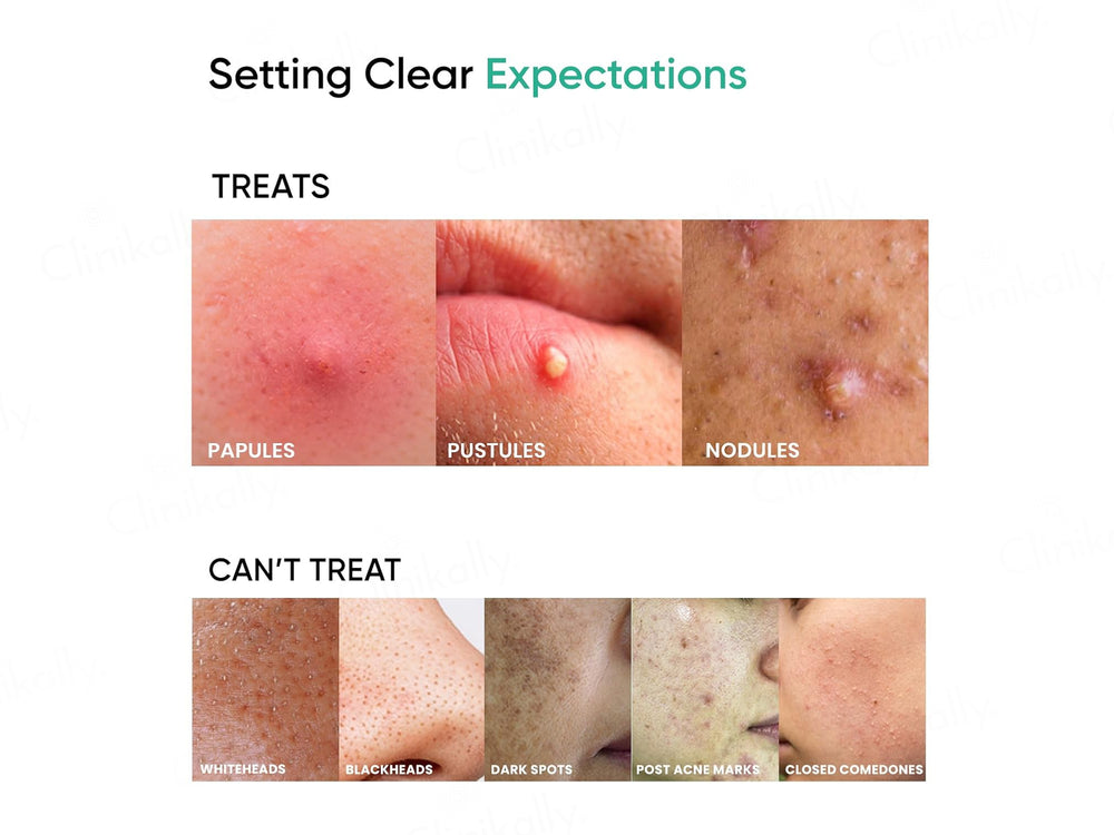 SkinInspired AcNil3 Acne Corrector