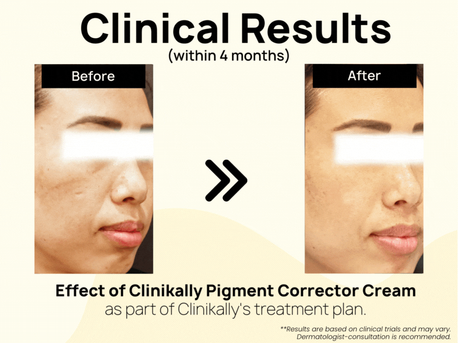 Clinikally Pigment Corrector Cream