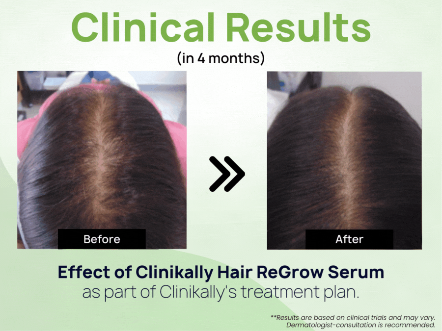 Clinikally Hair ReGrow Serum