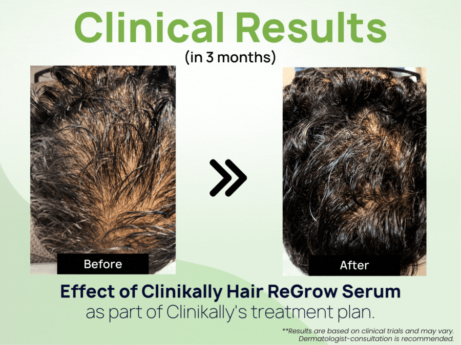 Clinikally Hair ReGrow Serum