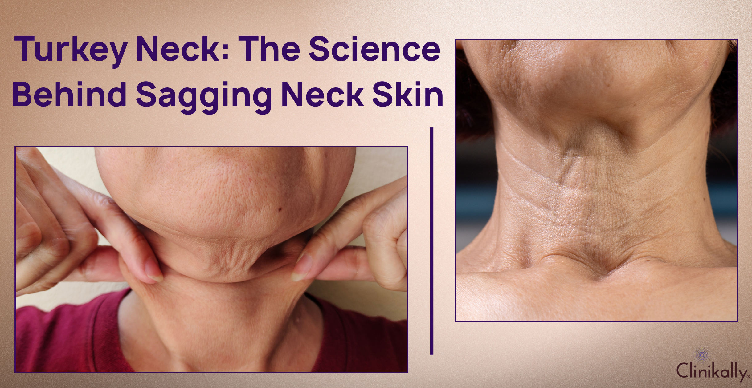 Turkey Neck: The Science Behind Sagging Neck Skin