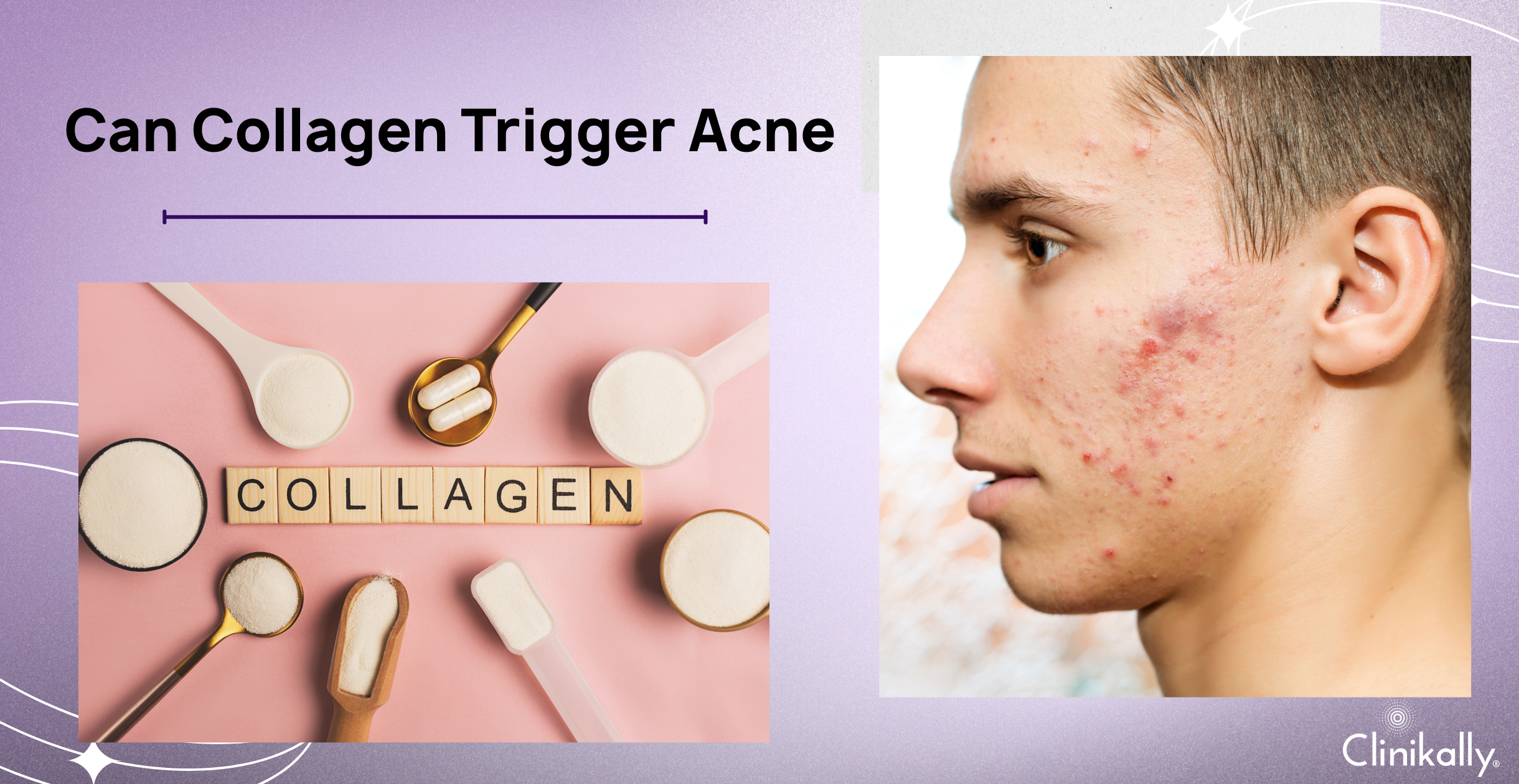 The Hidden Ingredient in Collagen That Triggers Acne