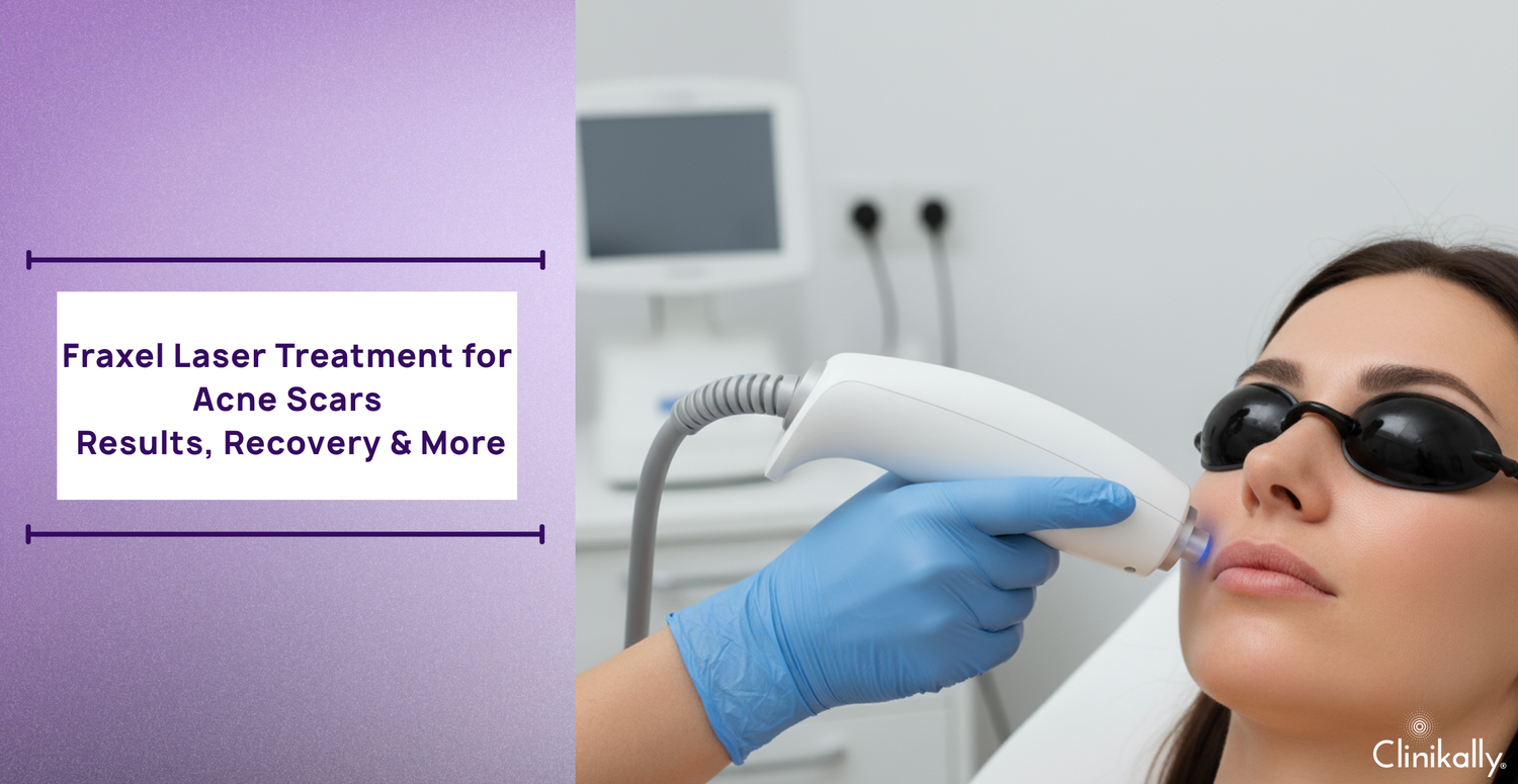 Fraxel Laser Treatment for Acne Scars: Results, Recovery & More