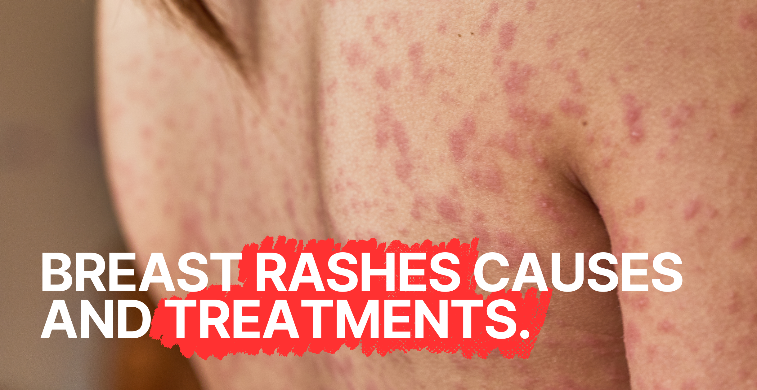 Breast Rashes Causes and Treatments: What You Need to Know| Clinikally