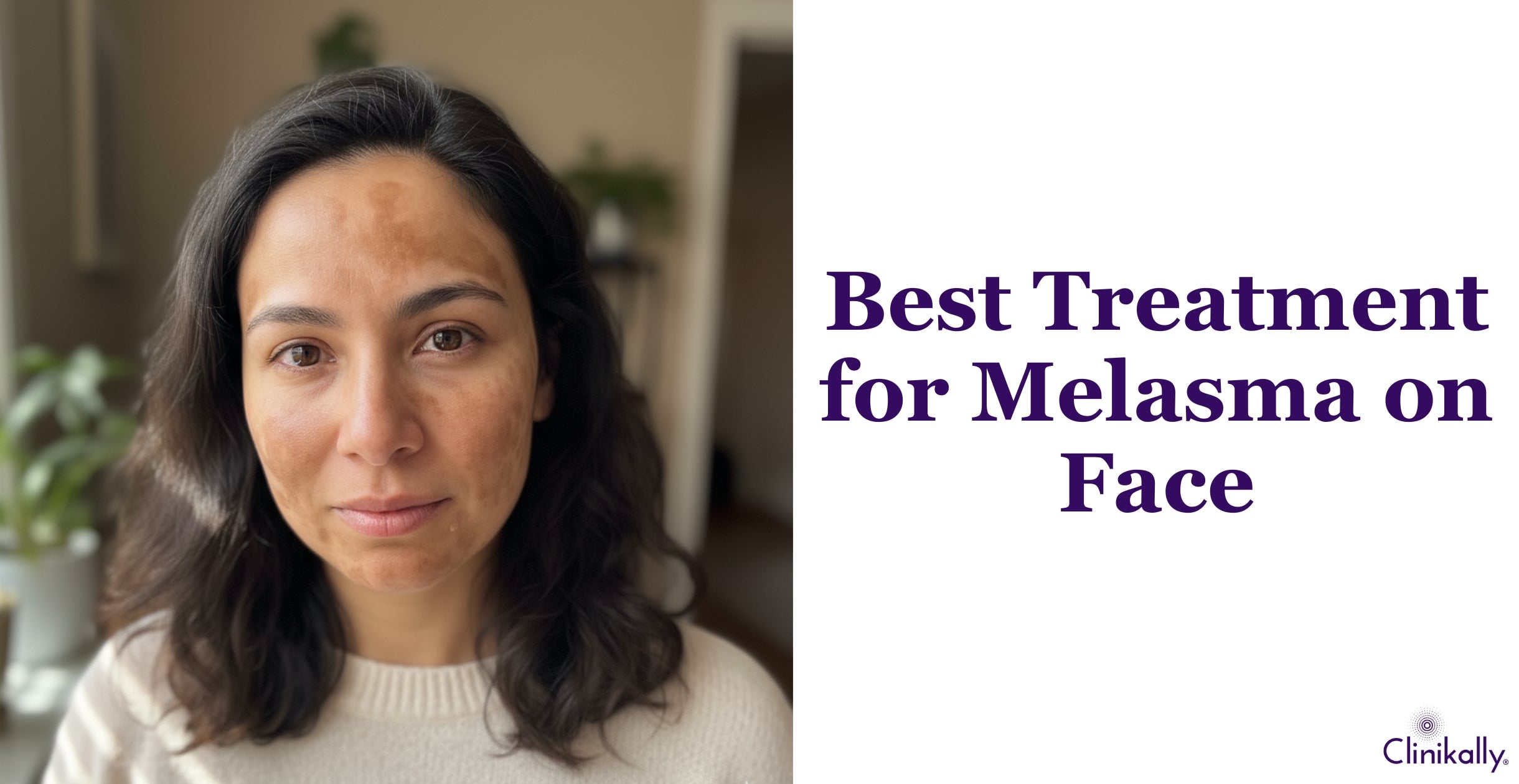 Best Treatment for Melasma on Face Recommended by Dermatologist