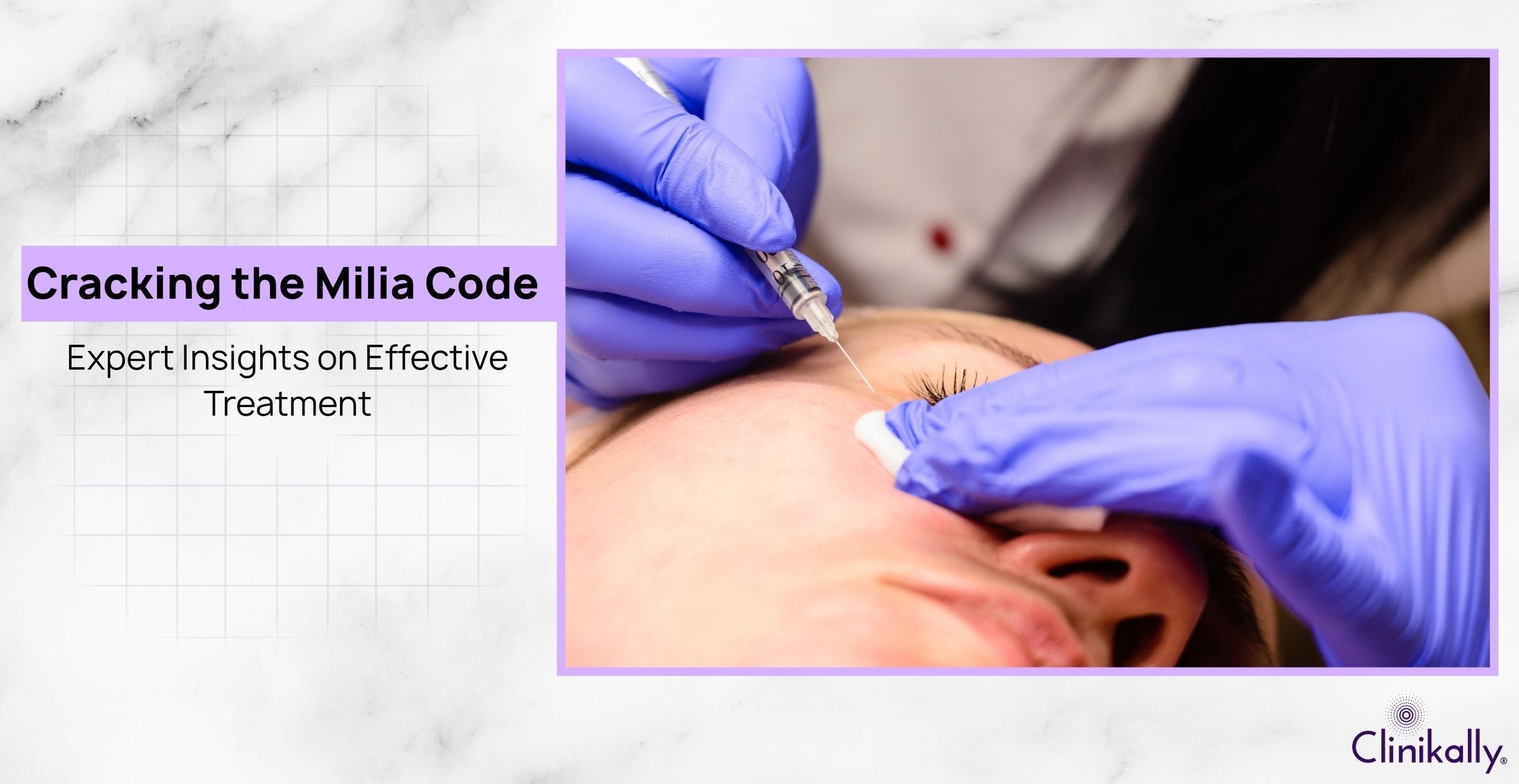 Cracking the Milia Code: Expert Insights on Effective Treatment