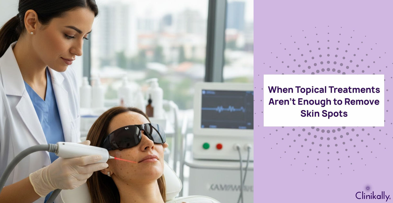 When Topical Treatments Aren’t Enough to Remove Skin Spots