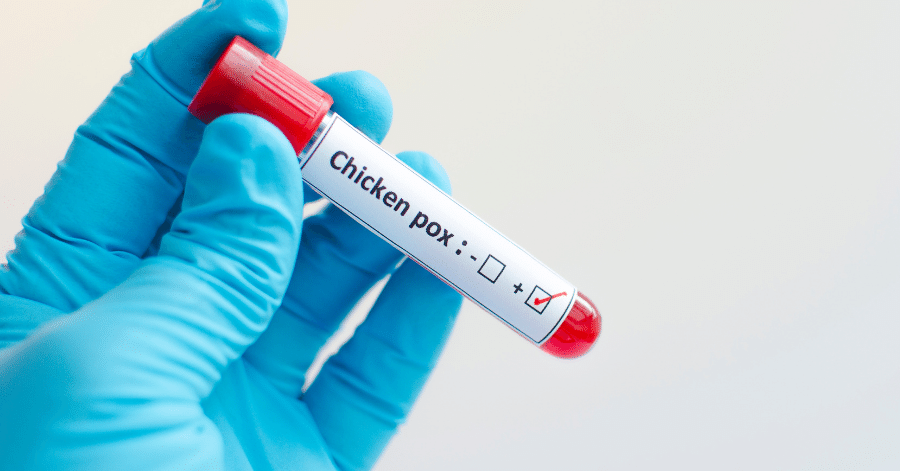 Treat chicken pox scars