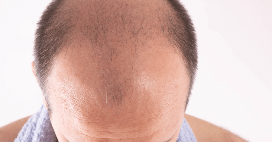 Male Pattern Baldness: Stages, Treatment & Prevention