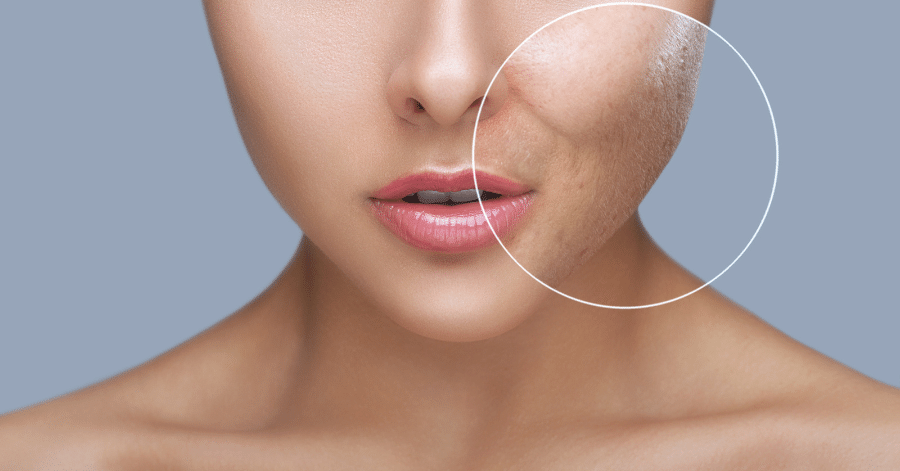 6 DIY Acne Treatment Tips for Clear & Healthy Skin
