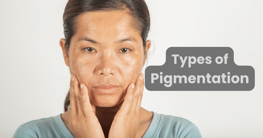 Types of pigmentation