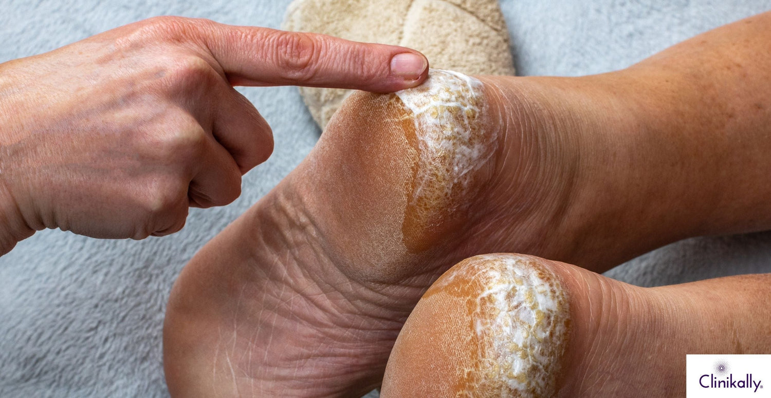 Best Cracked Heel Cream for Soft & Smooth Feet