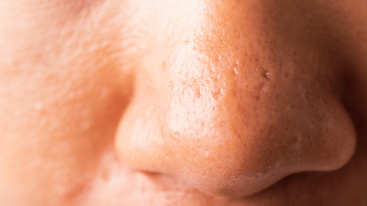 how to remove blackheads on nose 