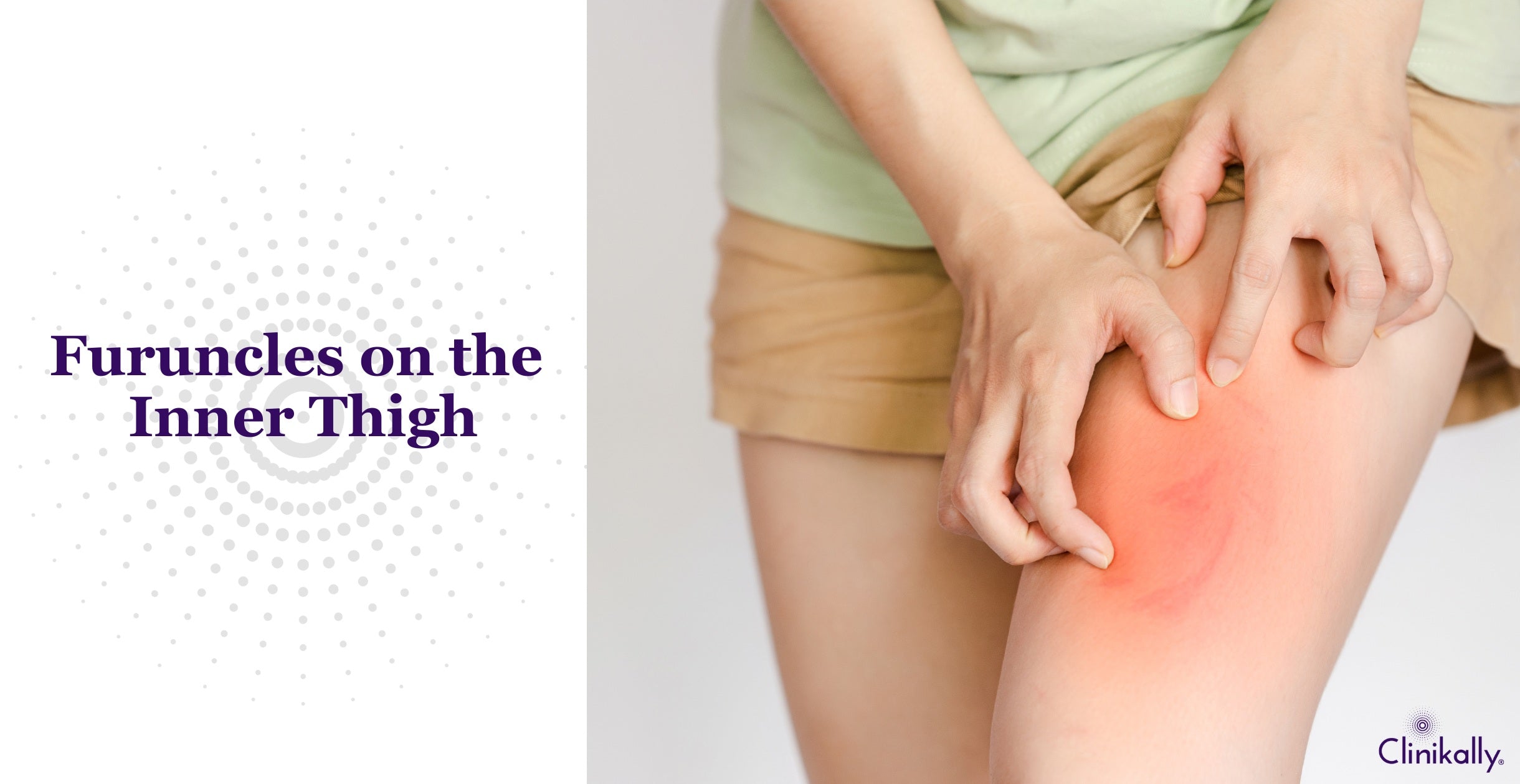 Inner Thigh Boils: Understanding Causes, Treatments, and Prevention