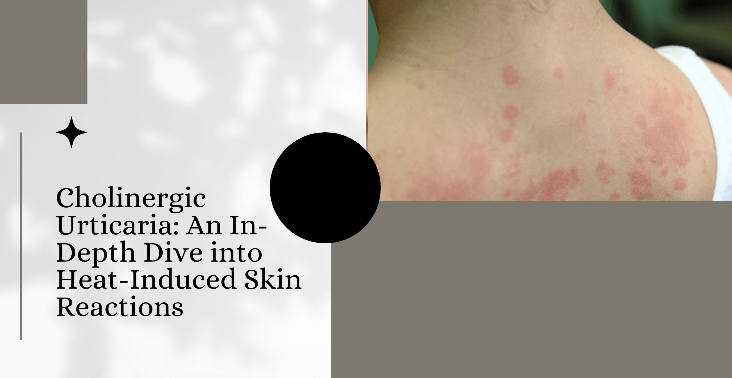 Cholinergic Urticaria: An In-Depth Dive into Heat-Induced Skin Reactions