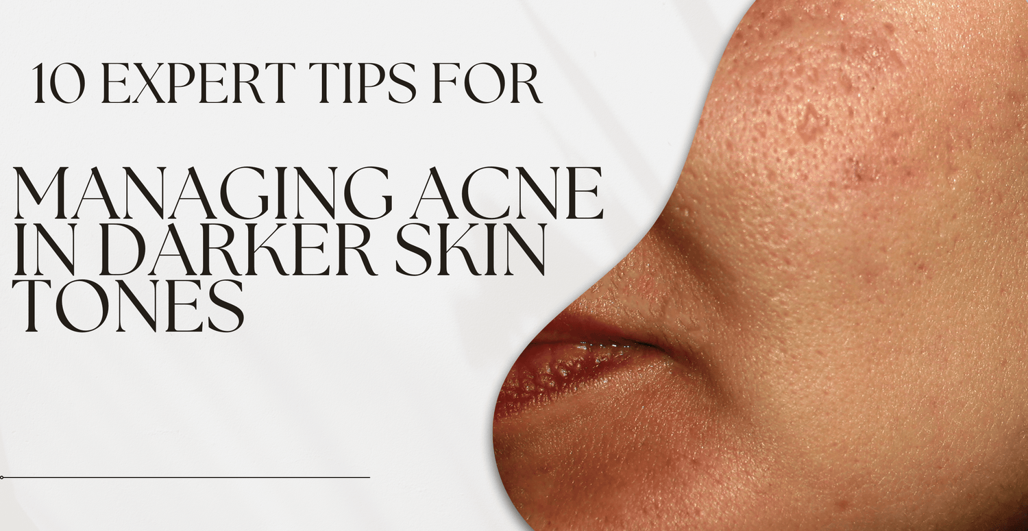 10 Expert Tips for Managing Acne in Darker Skin Tones