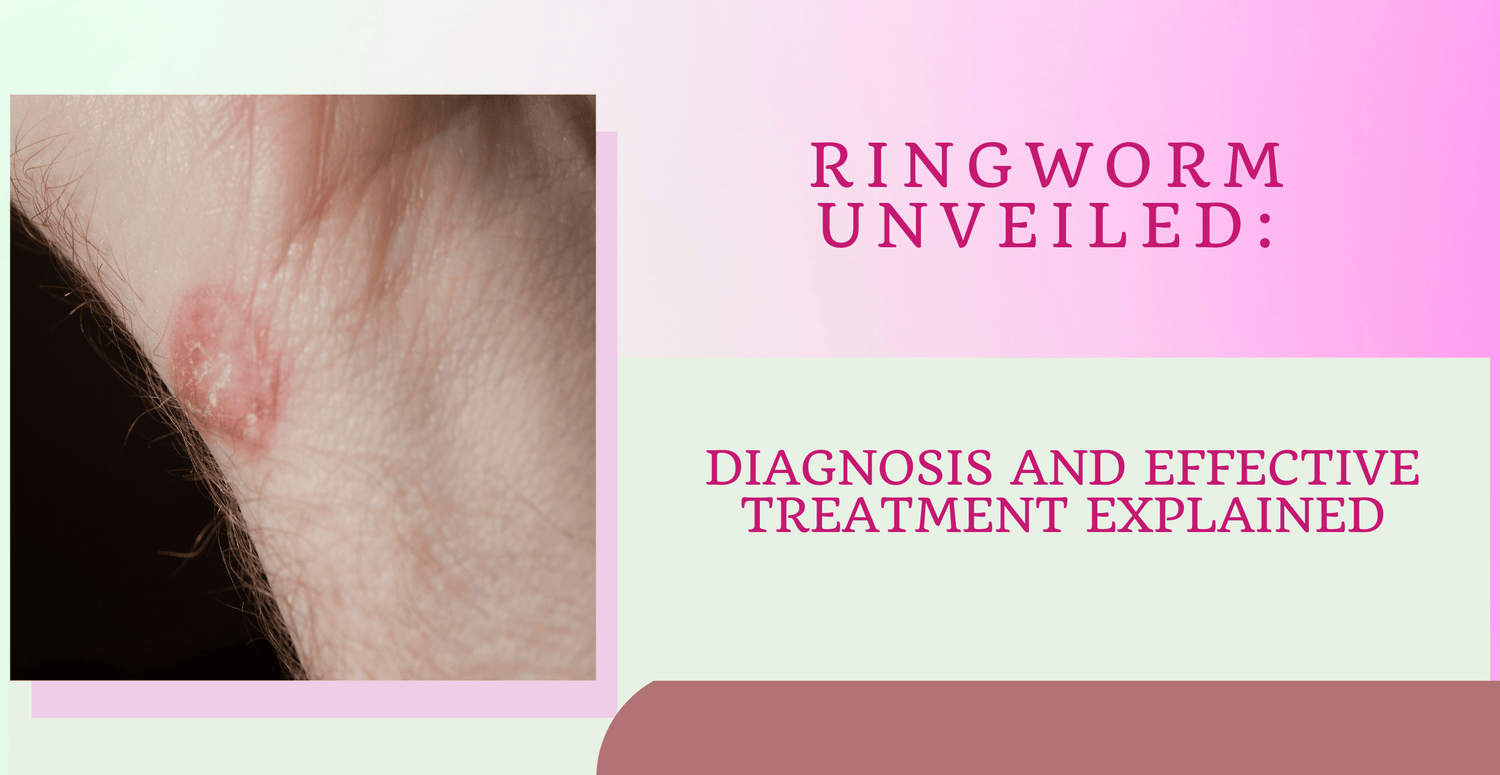 Ringworm Unveiled: Diagnosis and Effective Treatment Explained | Clinikally