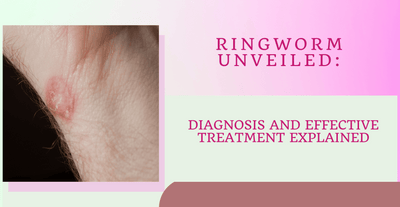 Ringworm Unveiled: Diagnosis and Effective Treatment Explained