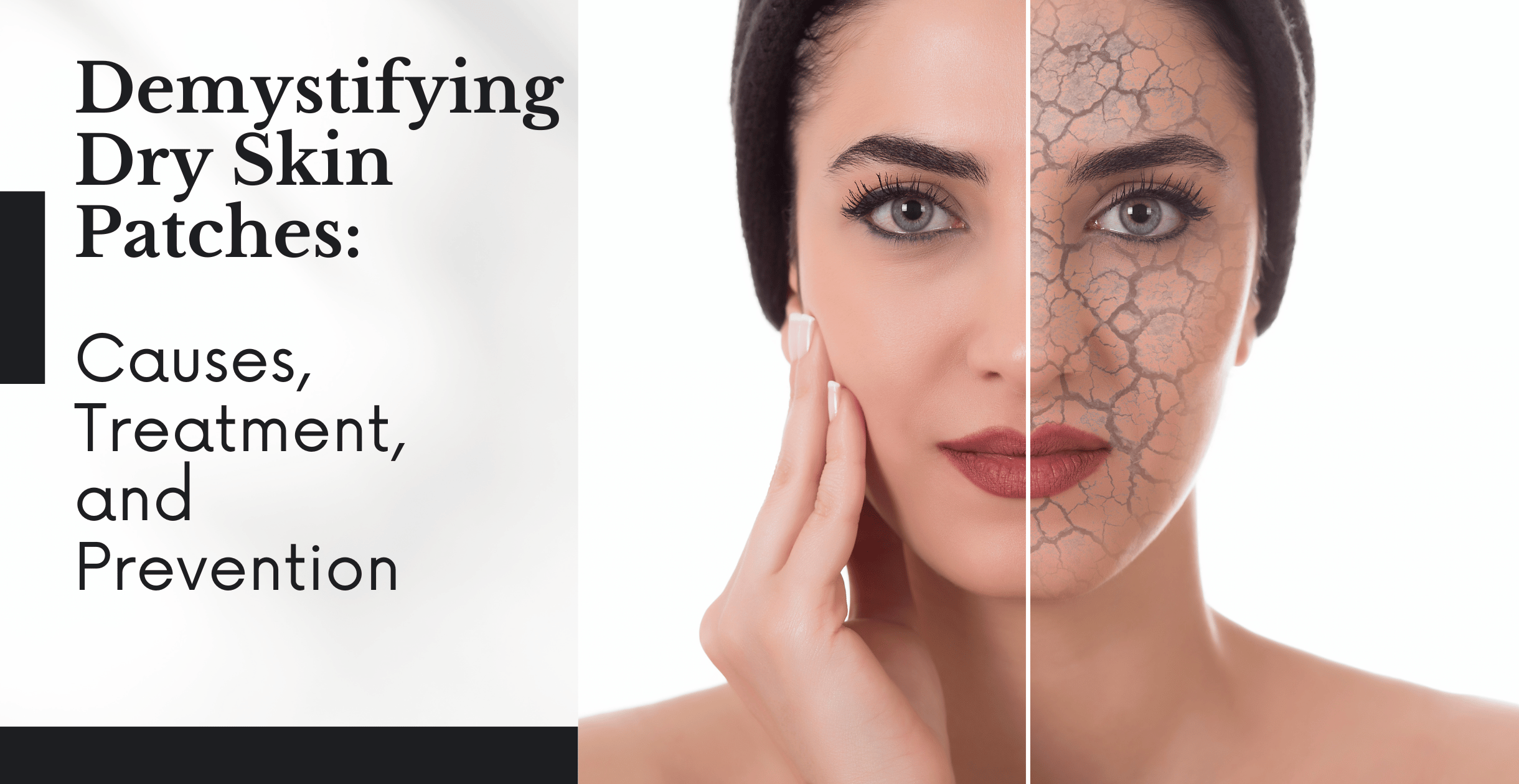 Demystifying Dry Skin Patches: Causes, Treatment, and Prevention