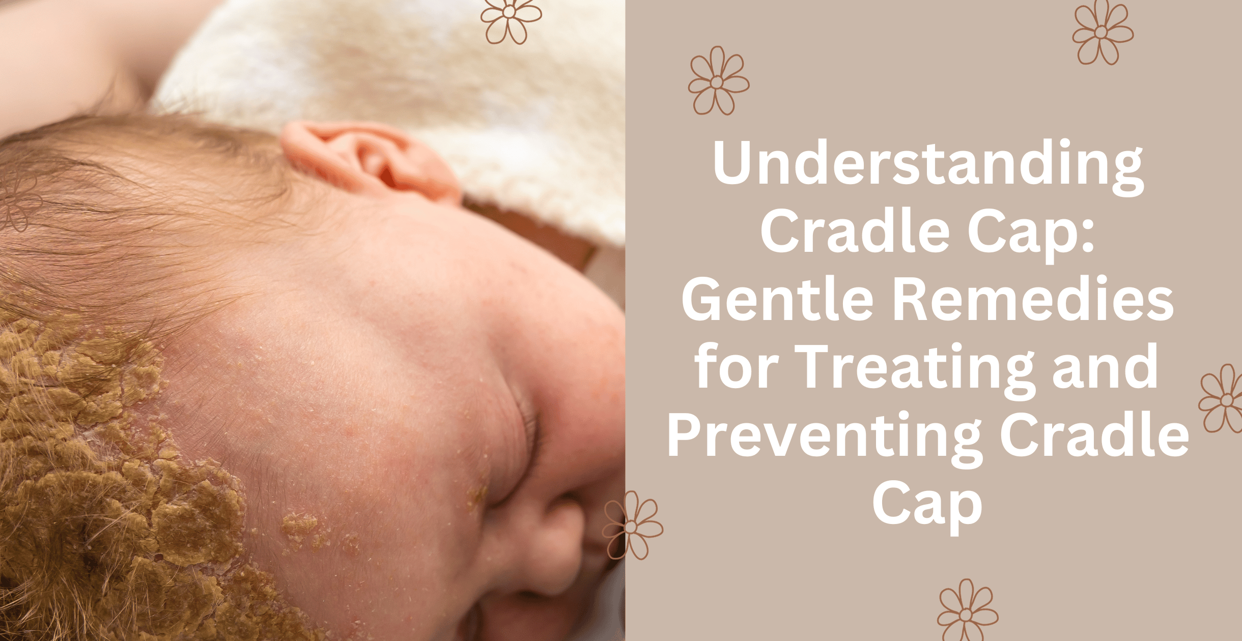 Understanding Cradle Cap: Gentle Remedies for Treating and Preventing Cradle Cap