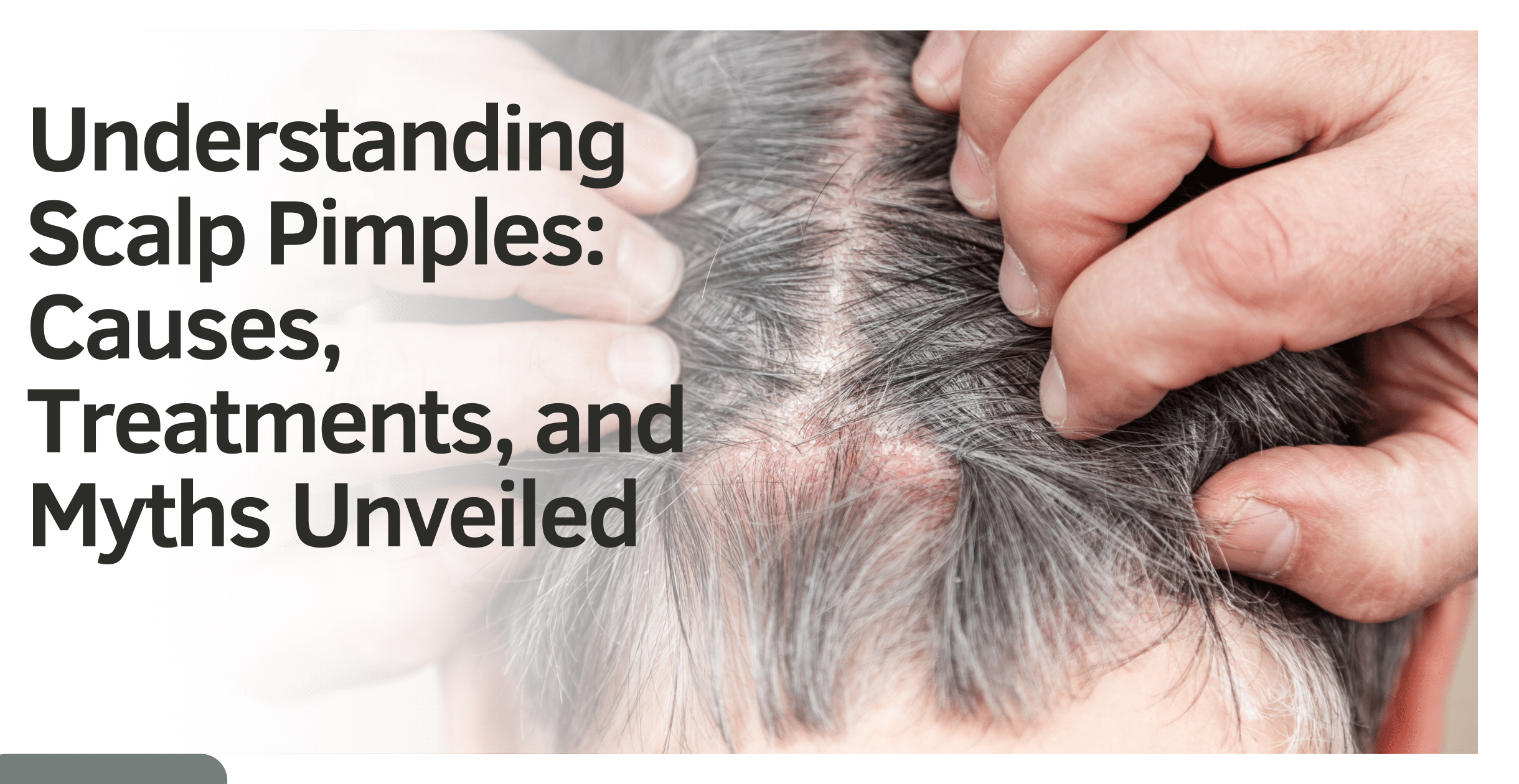 Understanding Scalp Pimples: Causes, Treatments, and Myths Unveiled