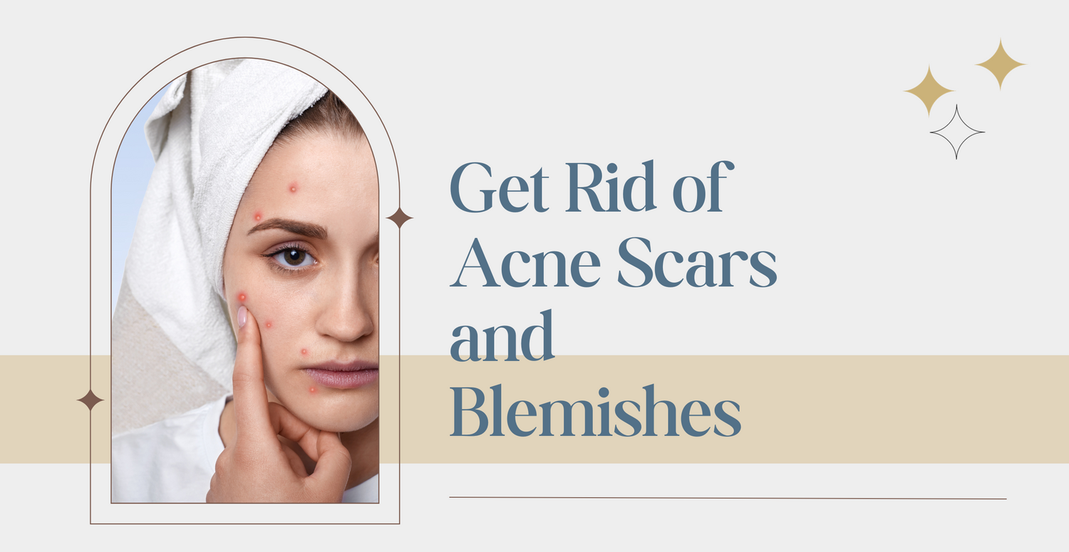 Get Rid of Acne Scars and Blemishes