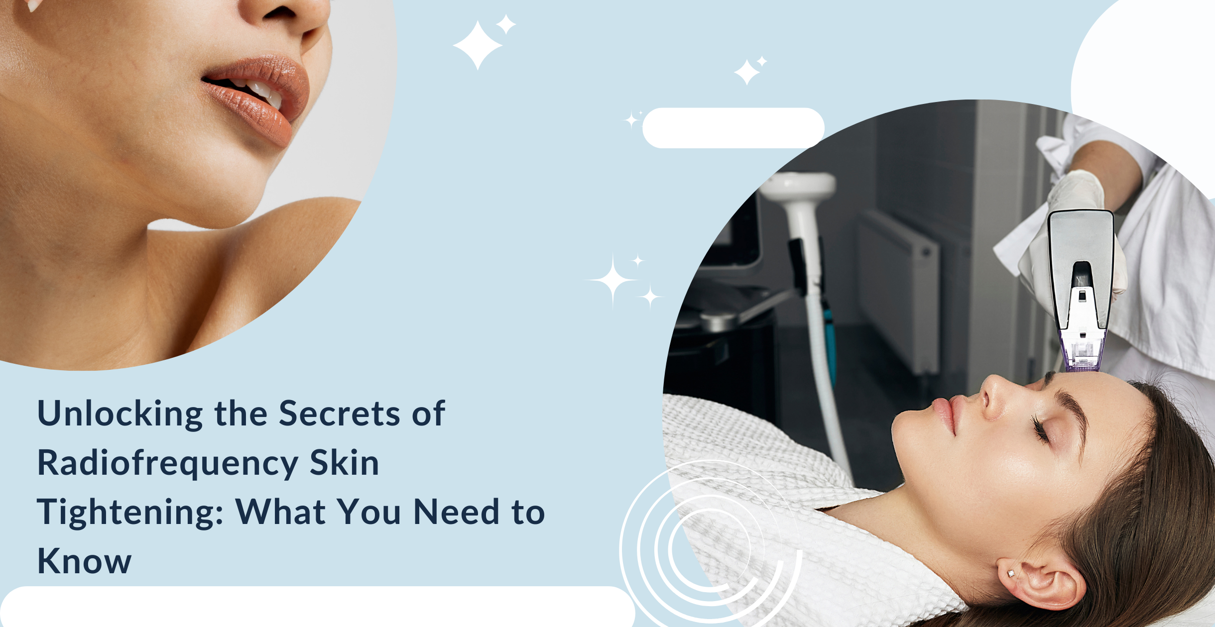 Unlocking the Secrets of Radiofrequency Skin Tightening: What You Need to Know