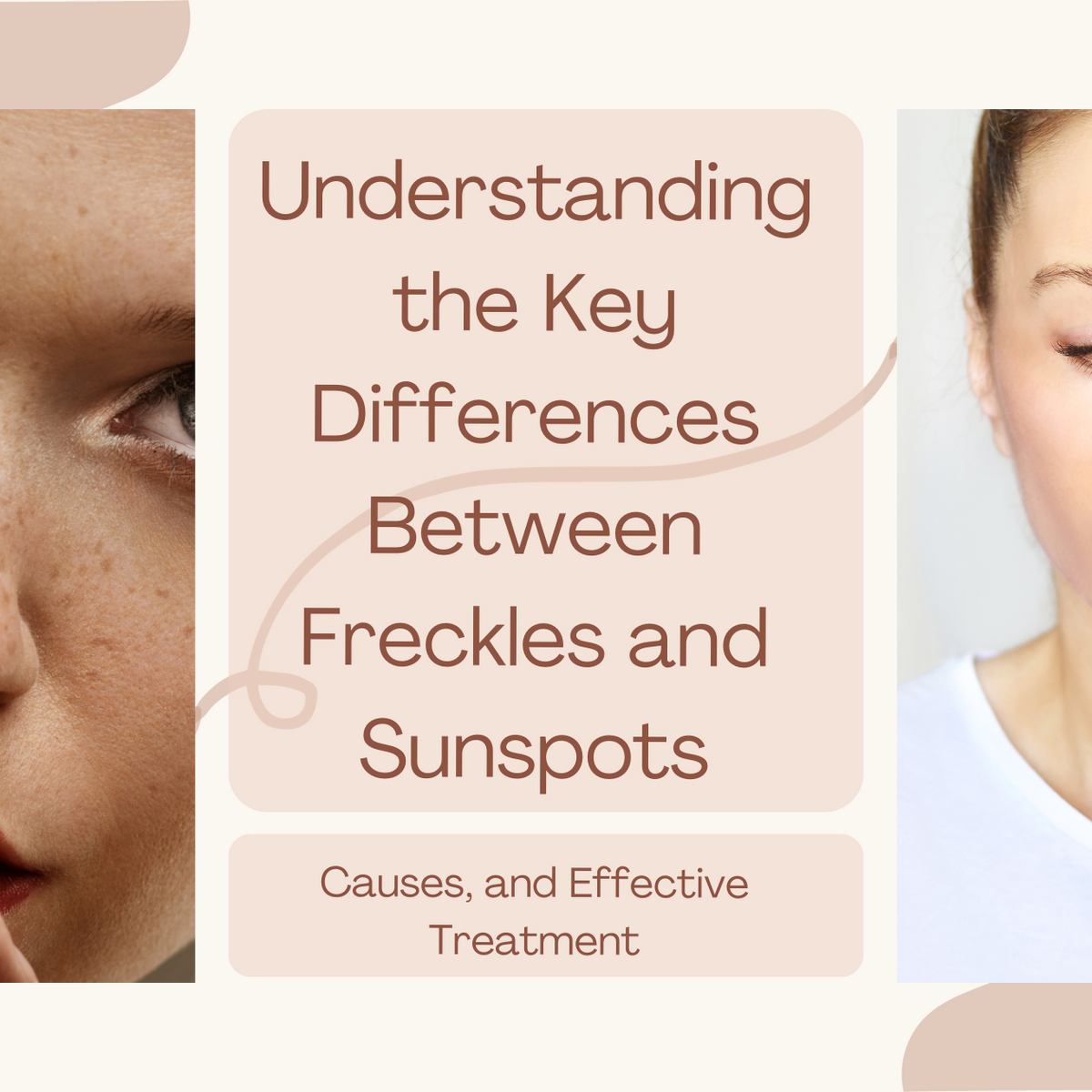 What's The Difference Between Freckles And Sun Spots?: Center