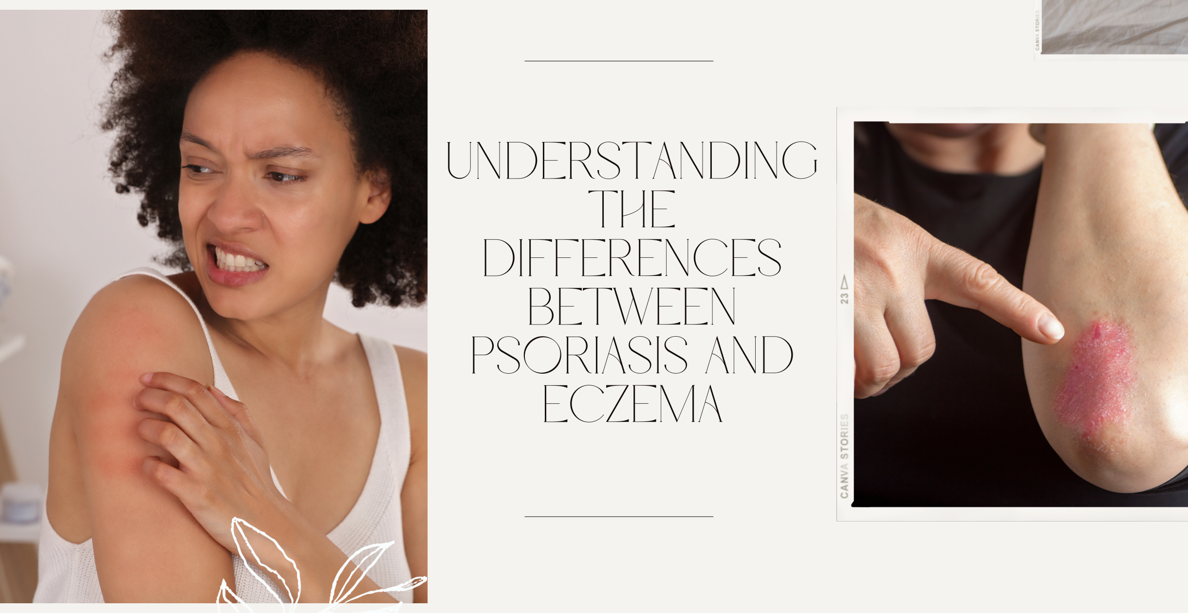 Distinguishing Skin Conditions: Understanding the Differences Between Psoriasis and Eczema