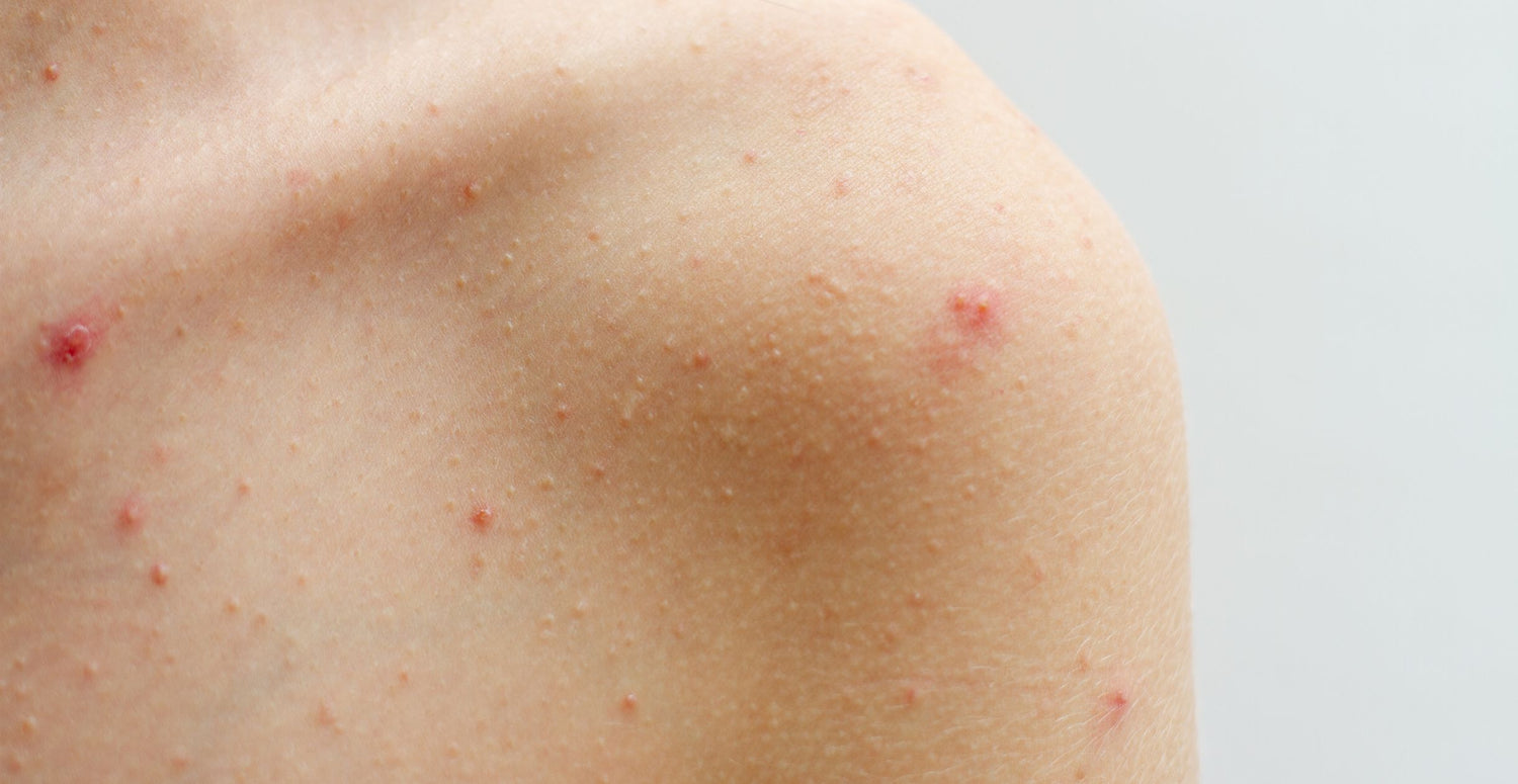 Acne Body Washes: What Works