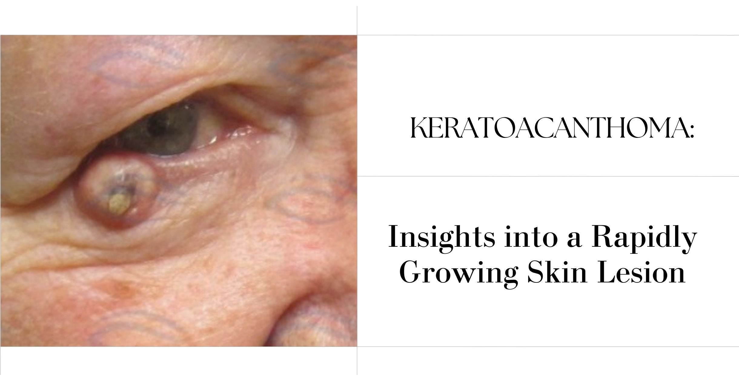 Keratoacanthoma: Insights into a Rapidly Growing Skin Lesion