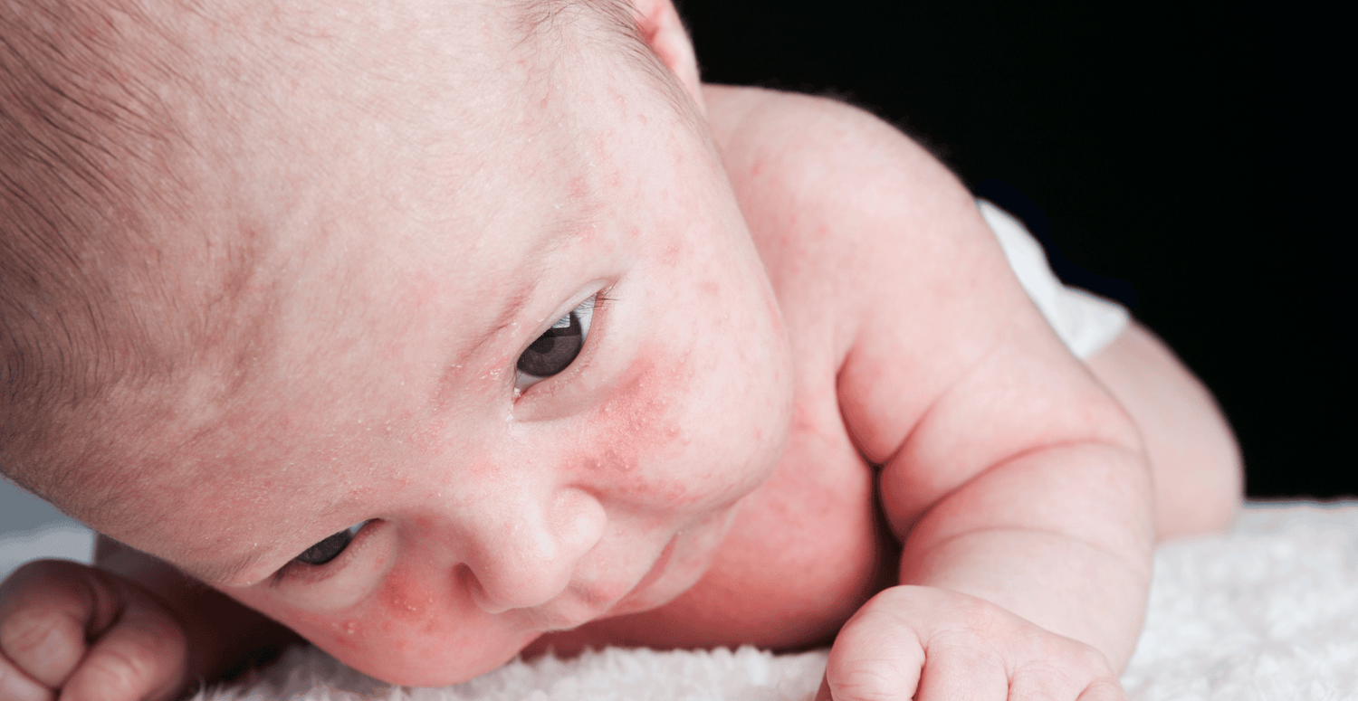 How to treat eczema in children