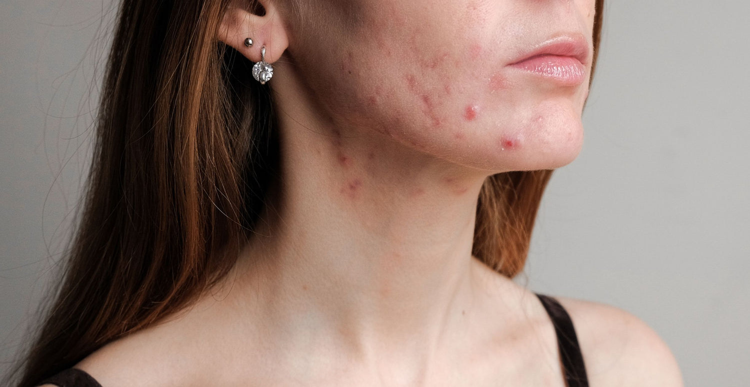 Hormonal vs Bacterial Acne: How to tell the difference