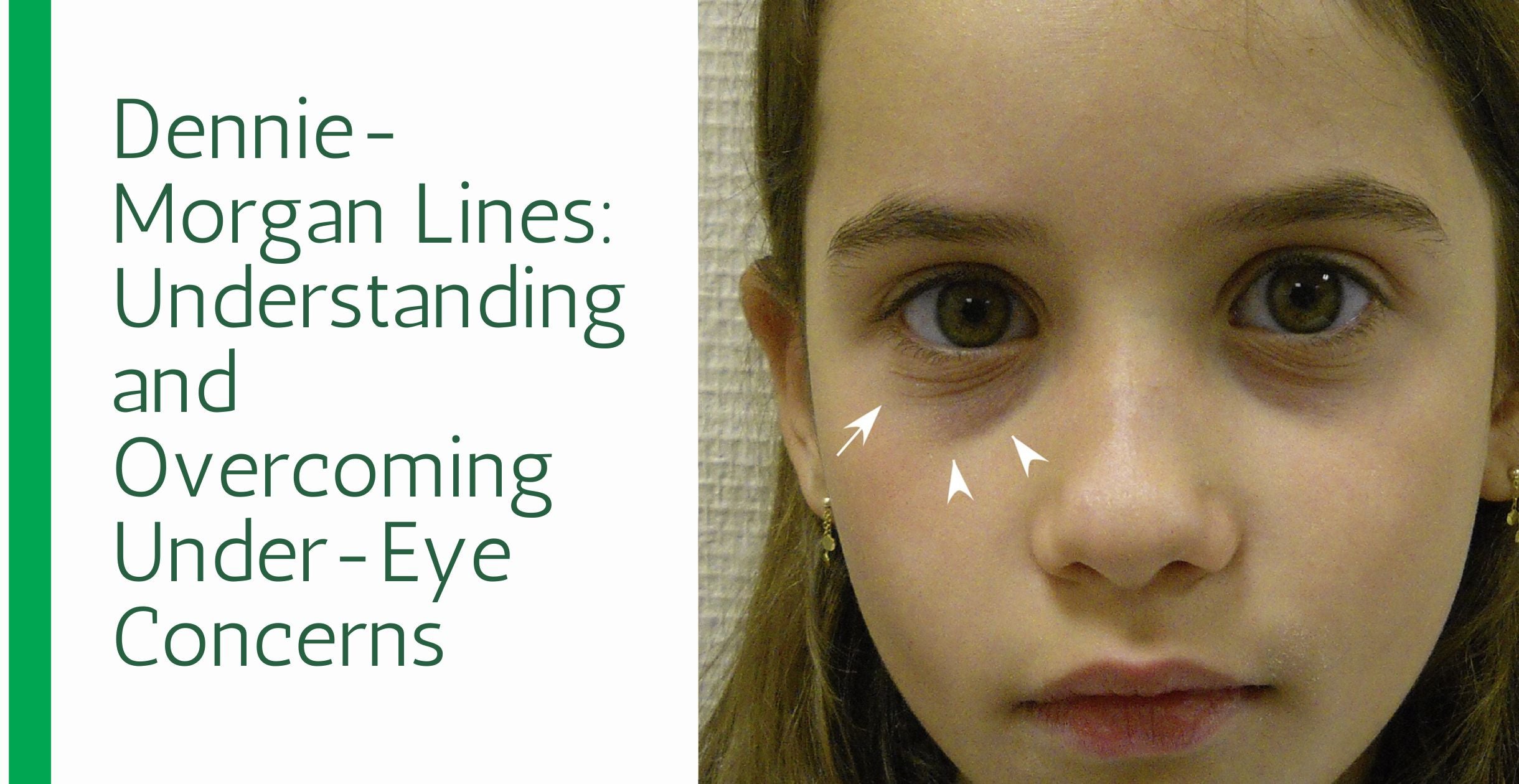 Dennie-Morgan Lines: Understanding and Overcoming Under-Eye Concerns