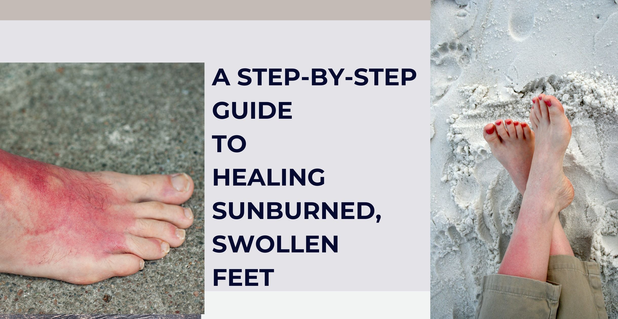 A Step-by-Step Guide to Healing Sunburned, Swollen Feet