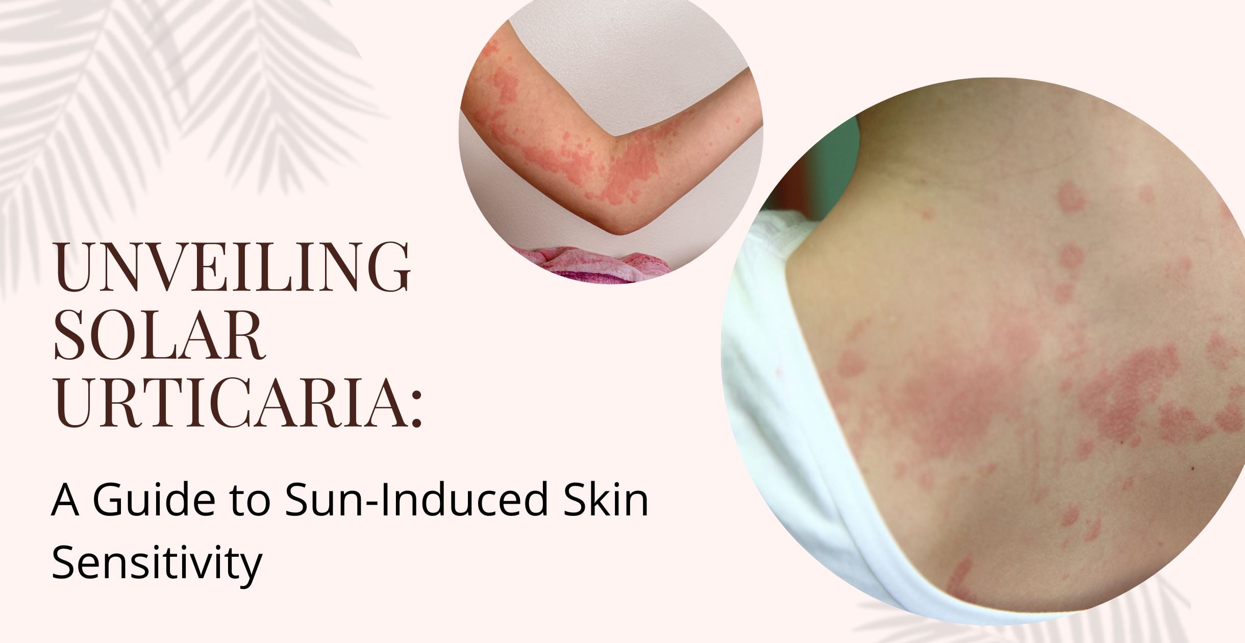 Unveiling Solar Urticaria: A Guide to Sun-Induced Skin Sensitivity