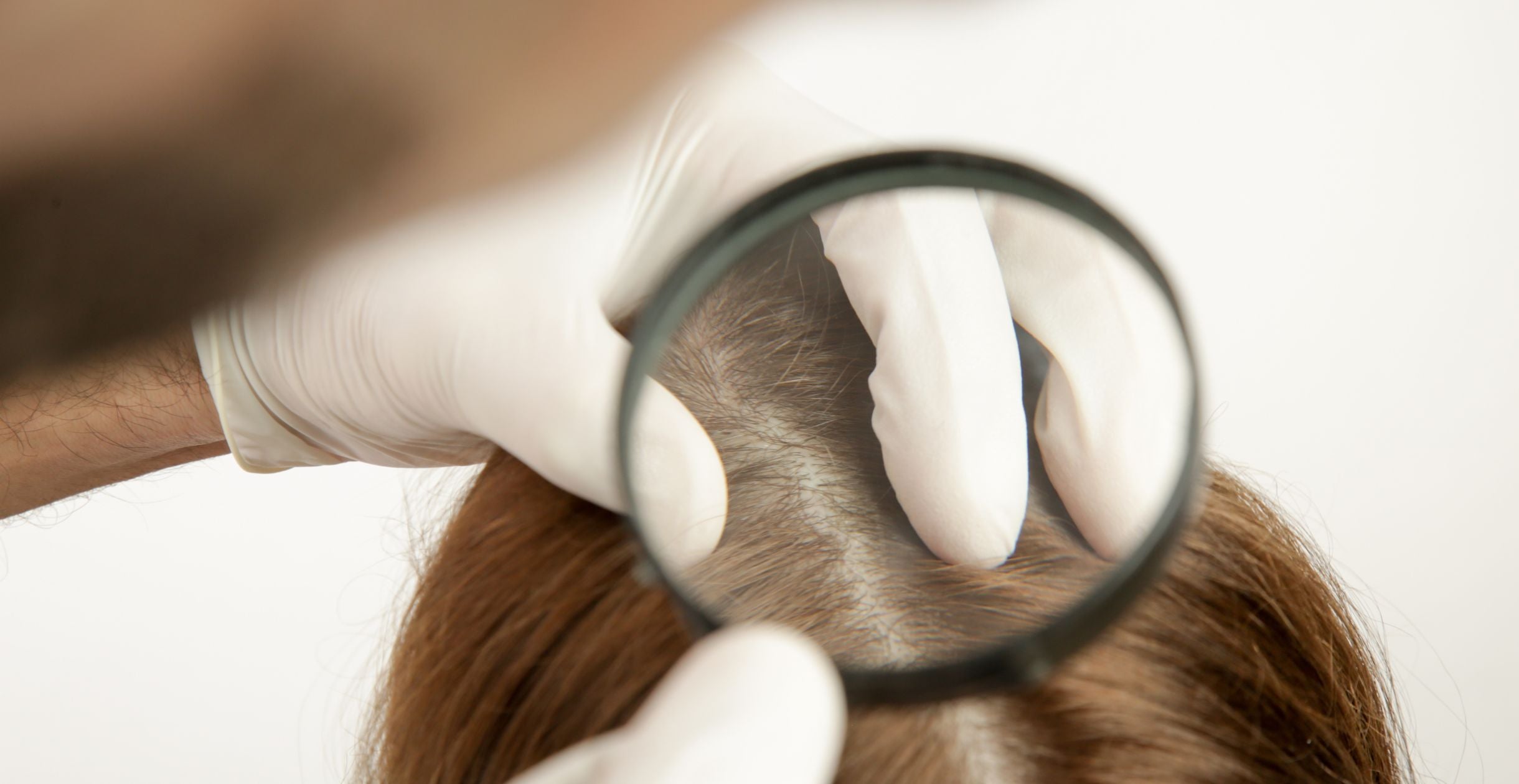 Decoding Scalp Acne: Understanding Causes and Finding Solutions