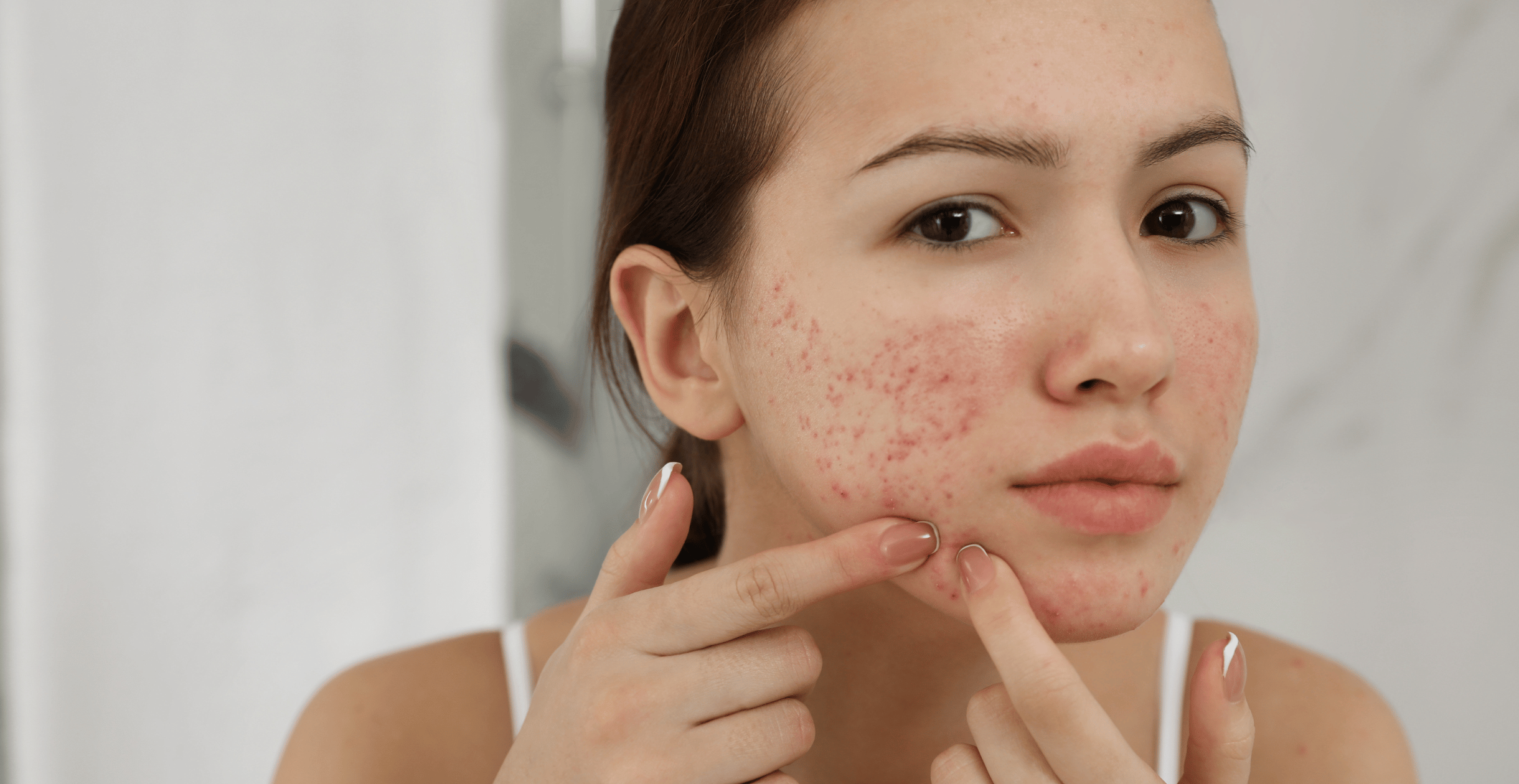 Teenage acne vs adult acne
