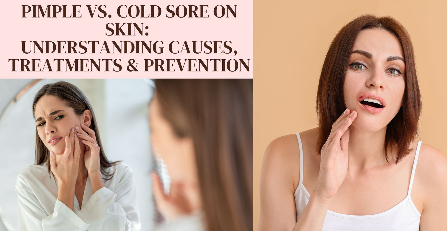 Pimple vs. Cold Sore on Skin: Understanding Causes, Treatments & Prevention